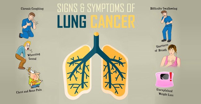 triệu chứng ung thư phổi 1 Ung thư phổi nguyên nhân và cách điều trị
