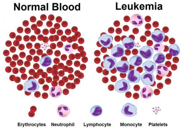 benh bach cau Bệnh Leukemia, bệnh bạch cầu là gì, điều trị thế nào?