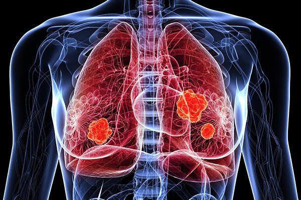 ung thu phoi Những người nên tầm soát ung thư phổi?