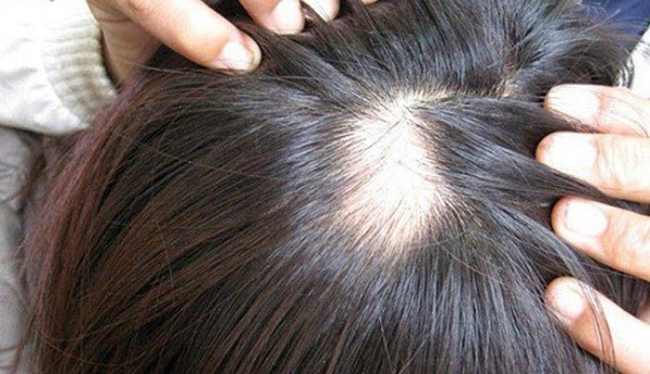 cach chua rung toc tung mang Rụng tóc? Nguyên nhân, triệu chứng và phương pháp điều trị?